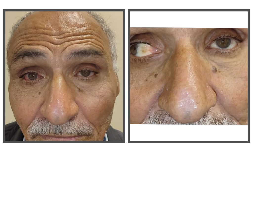 Harran Üniversitesi Hastanesi’nden Başarılı Operasyon