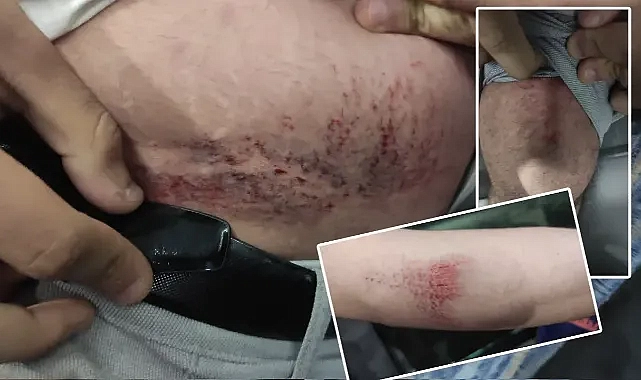 Harran Üniversitesi’nde korkuyu yaşadı! Yaralı öğrenci: Maalesef ki köpekten değersiziz!