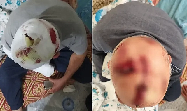 Şanlıurfa’da damat dehşeti! Kayınbabanın kafasına onlarca dikiş atıldı!