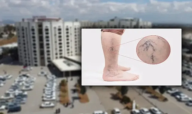 Urfa’da varis tedavisi yapılıyor mu?