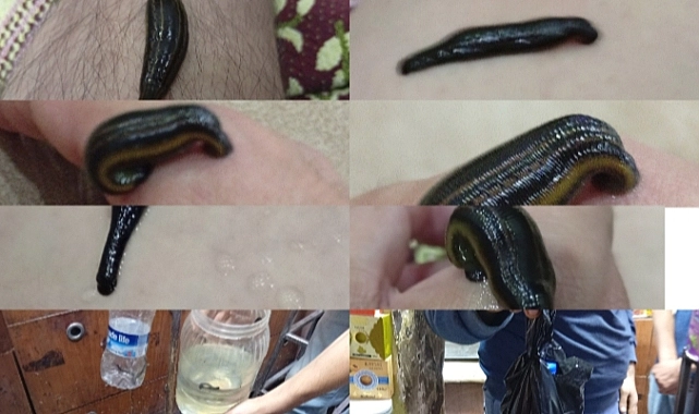 Şanlıurfa’da Sülükle Tedaviye Yoğun İlgi